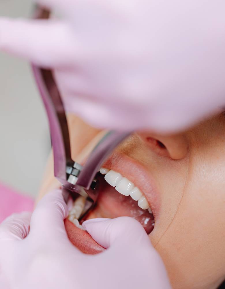Dental Extractions - Dental Studio Extracciones Dentales - Tijuana Dental Studio